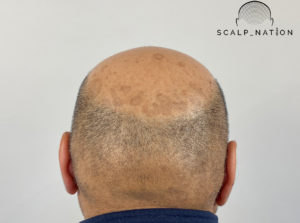 common hair follicles problems