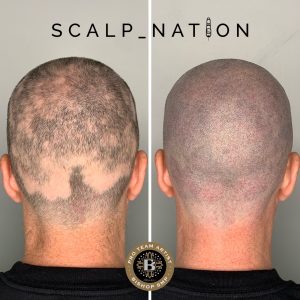 frontal fibrosing alopecia