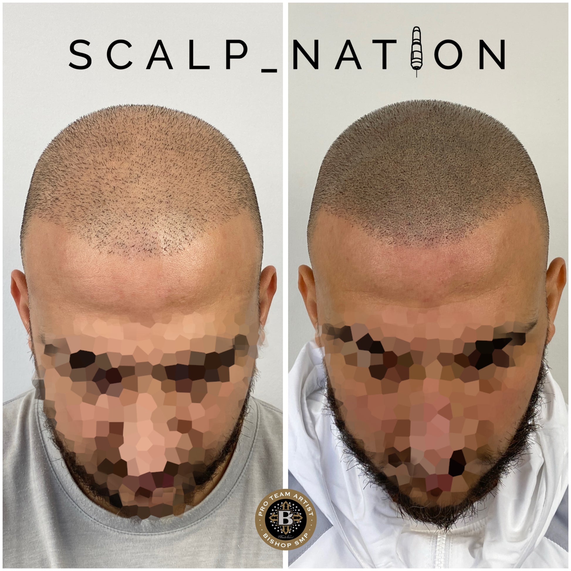 scalp micropigmentation after hair transplant