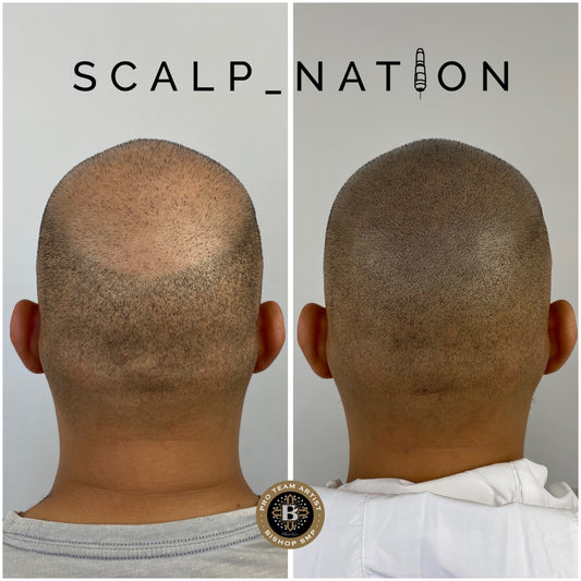 smp after hair transplant