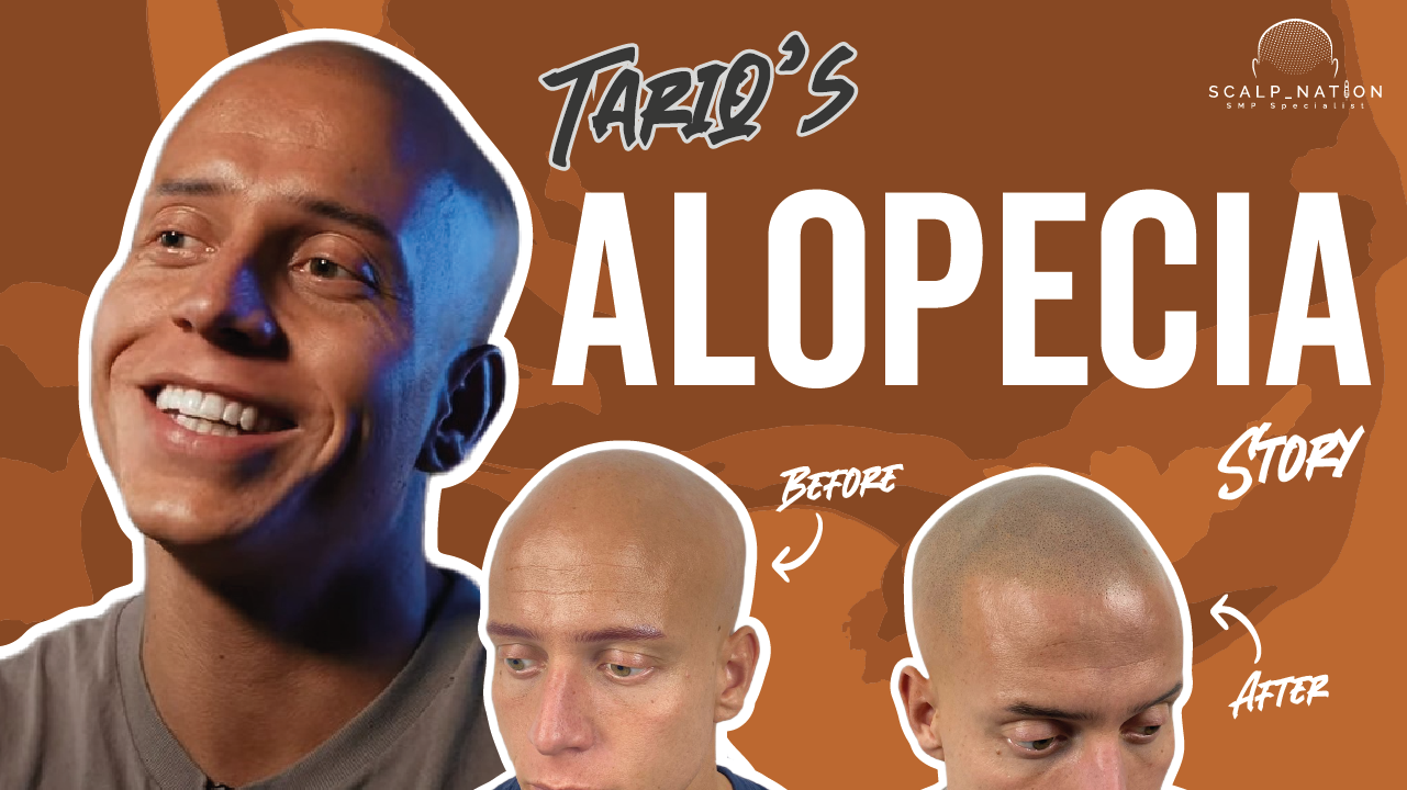 tariq alopecia scalp micropigmentation story