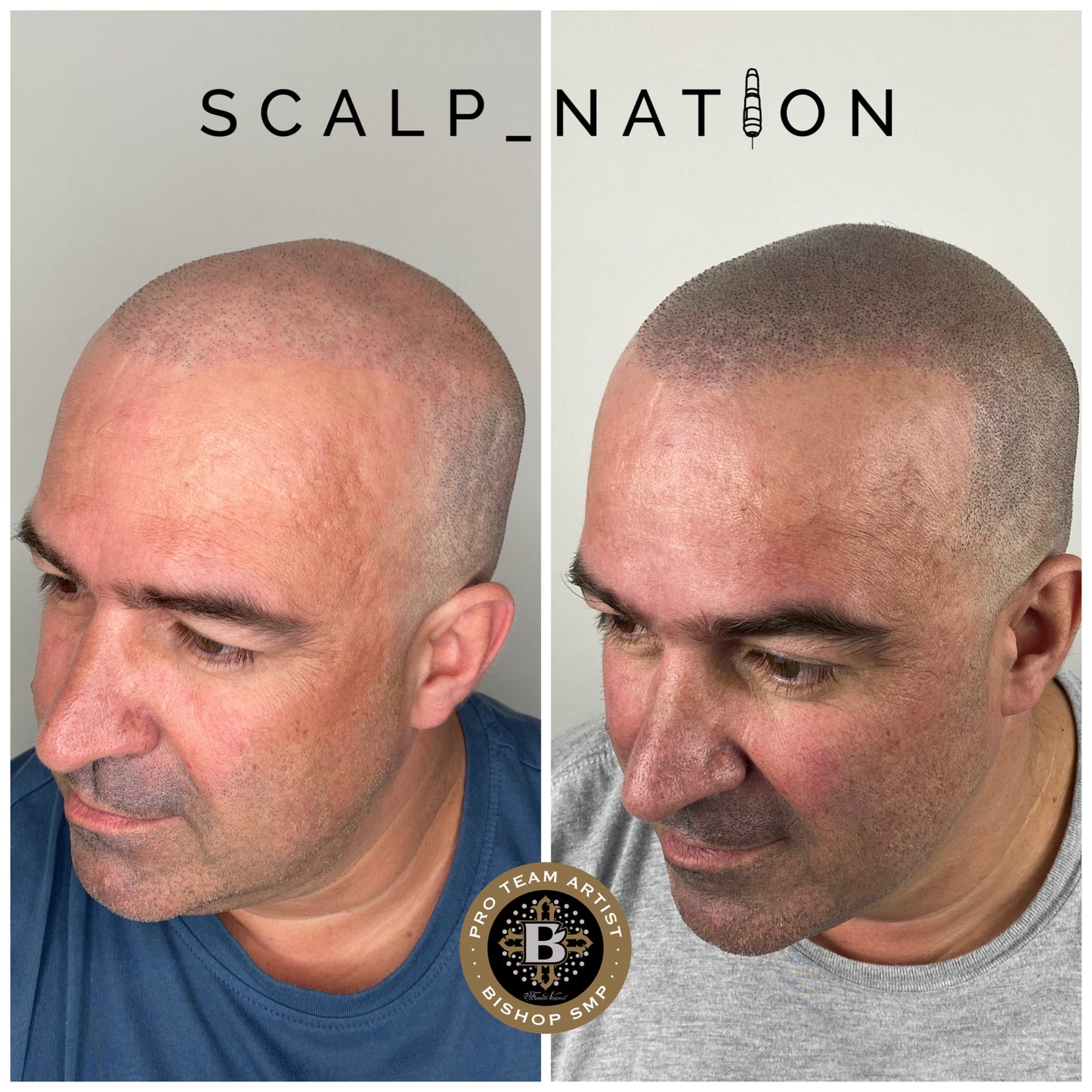 SMP After Hair Transplant