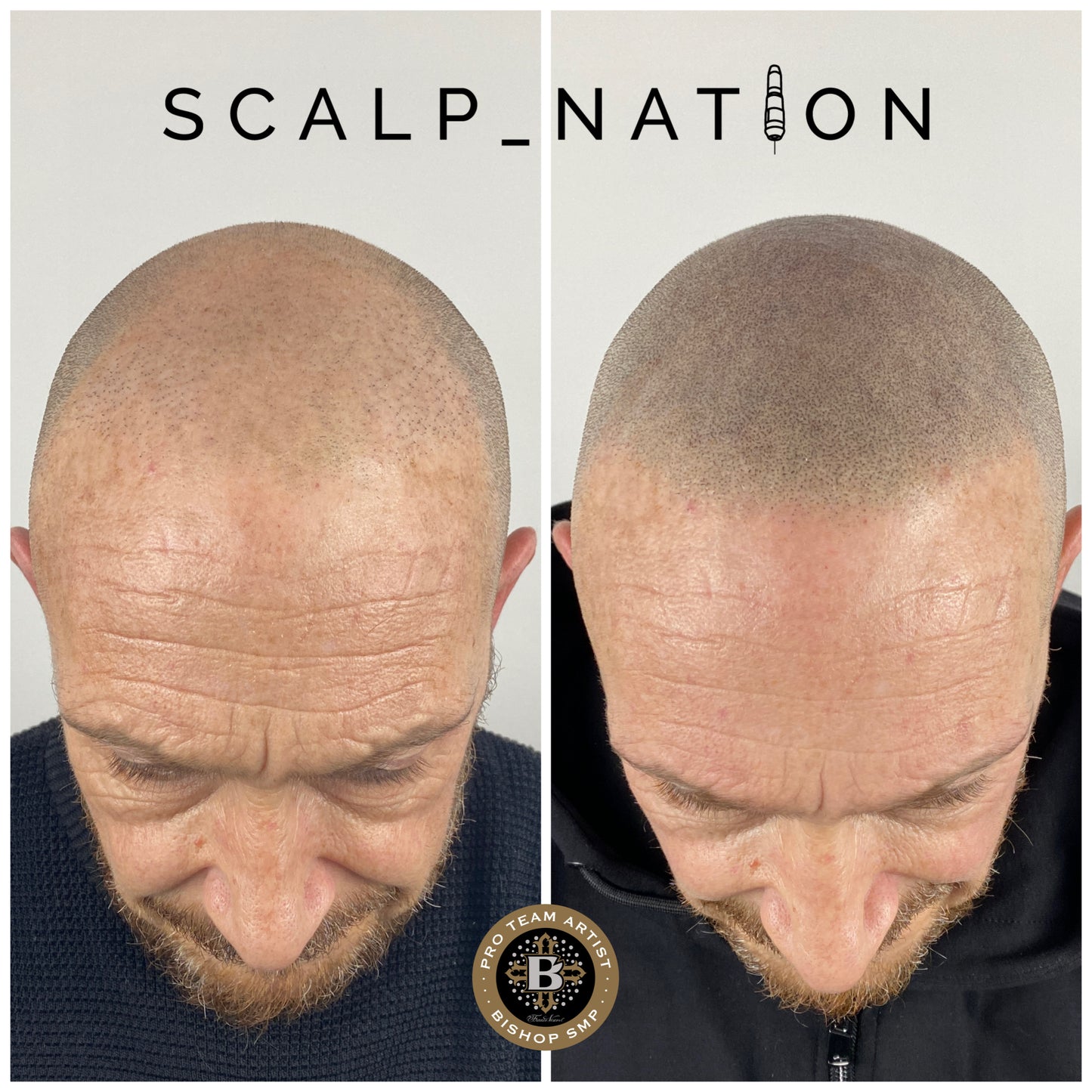 SMP After Hair Transplant
