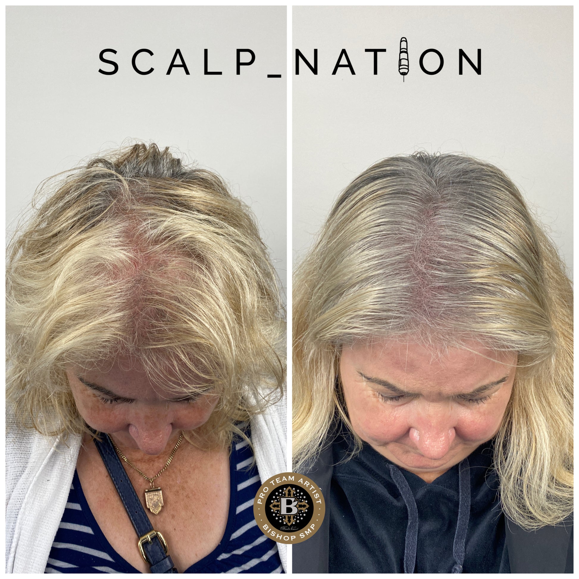 female density scalp micropigmenation 