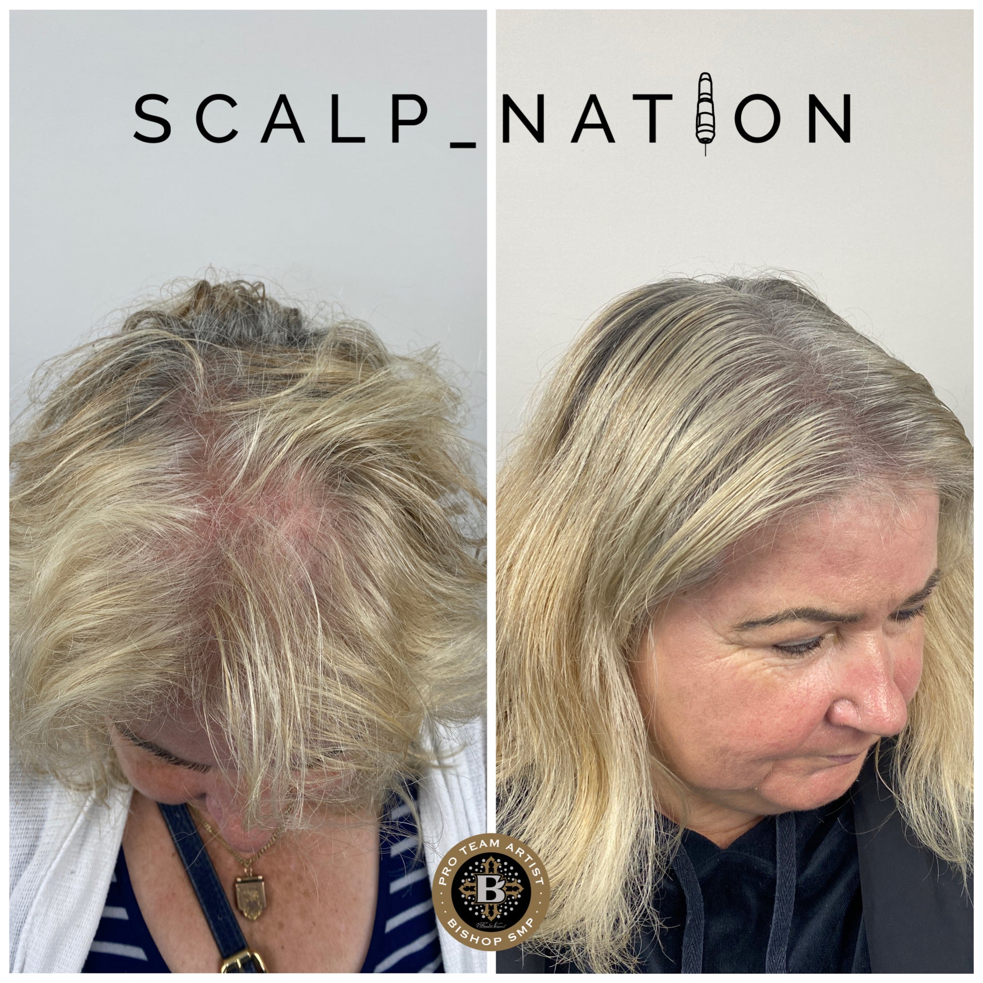 scalp micropigmentation for female long hair