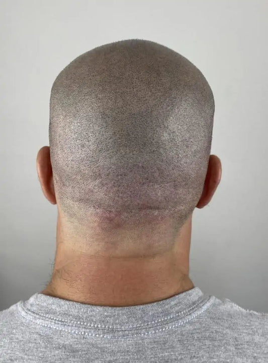 Scalp Micropigmentation For Scarring