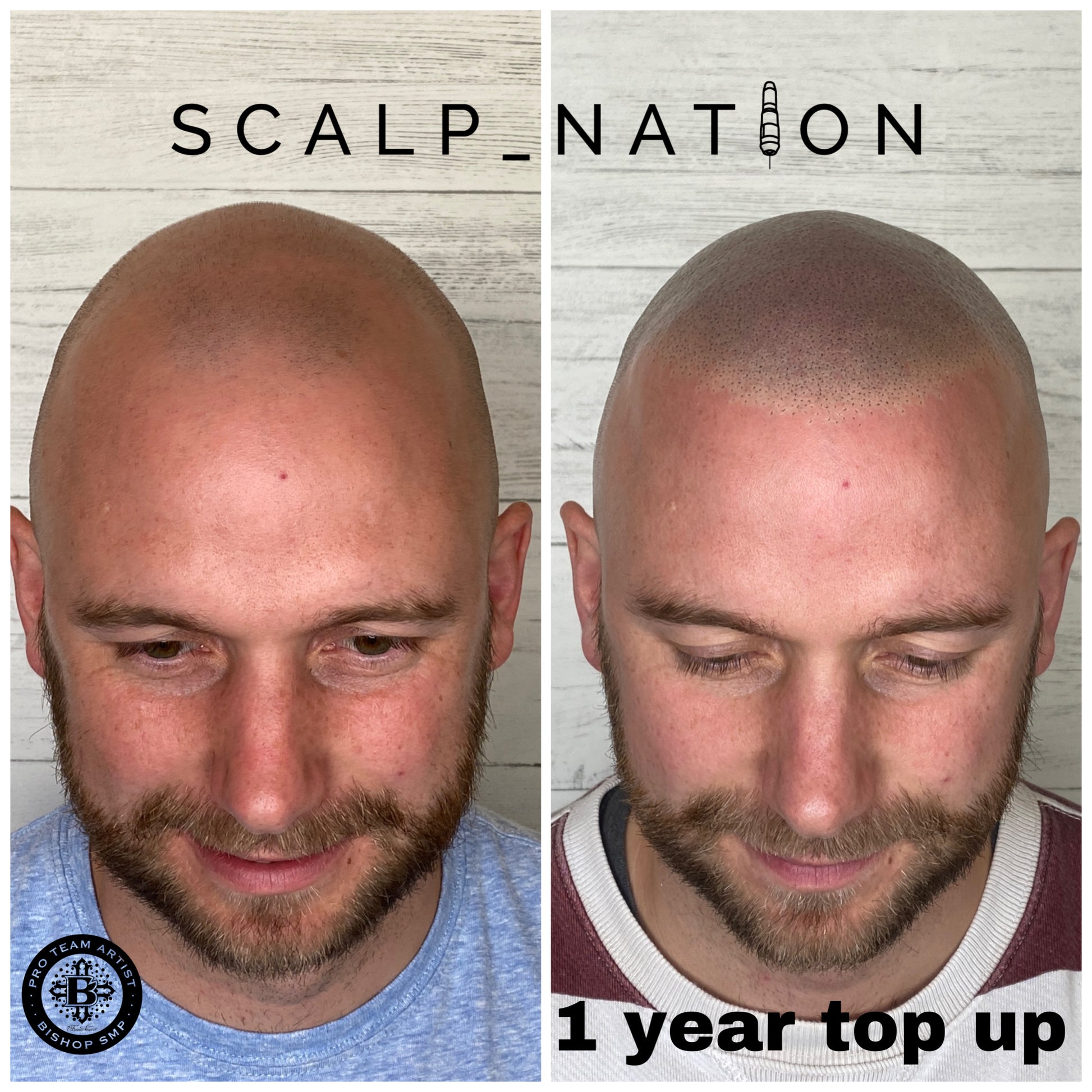 scalp micropigmentation top up