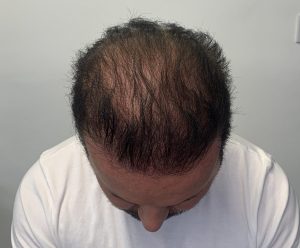 why do men bald