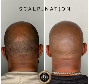 Scalp Micropigmentation for Darker Skin 3 dark skin smp