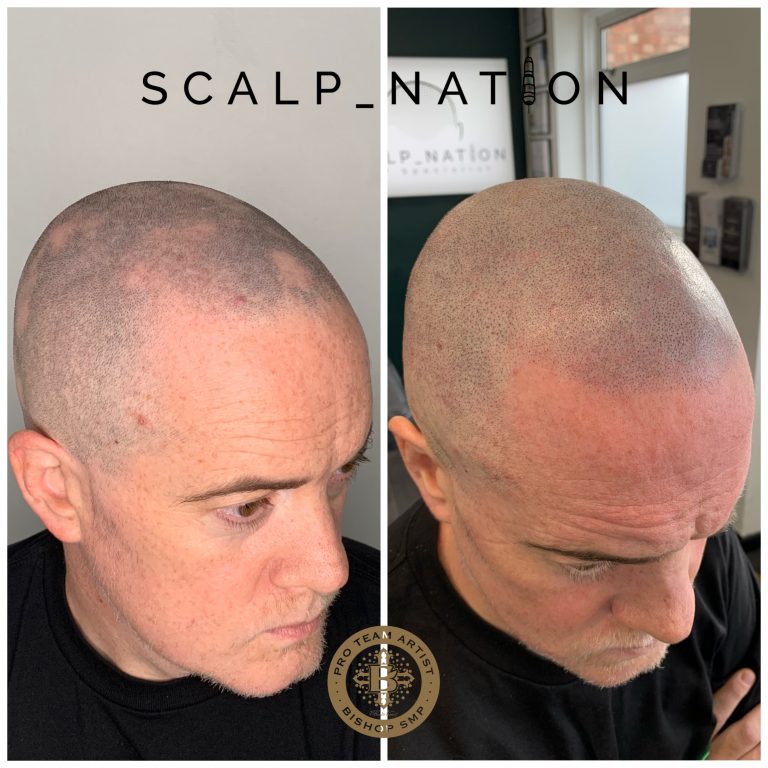 scalp-micro-pigmentation-for-alopecia-before