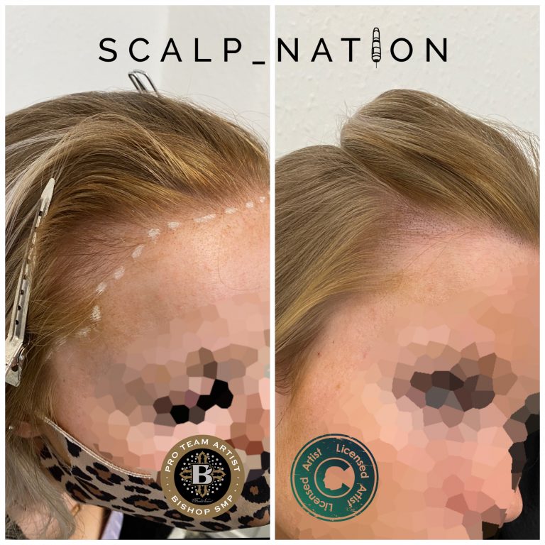 scalp-micro-pigmentation-for-women-before