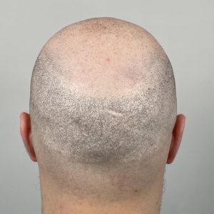 why do men bald