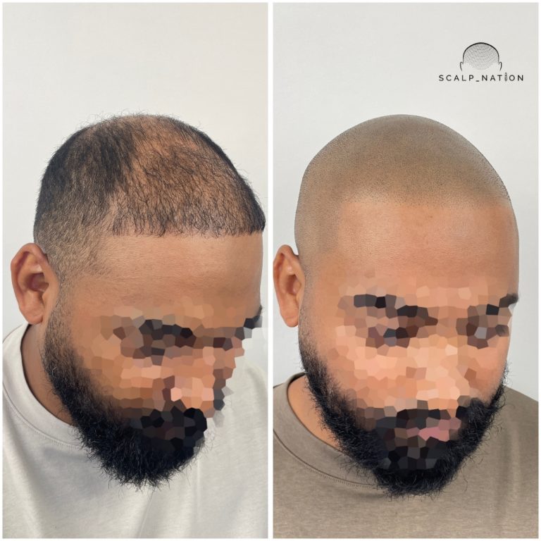 Scalp Micropigmentation Transformation Before And After