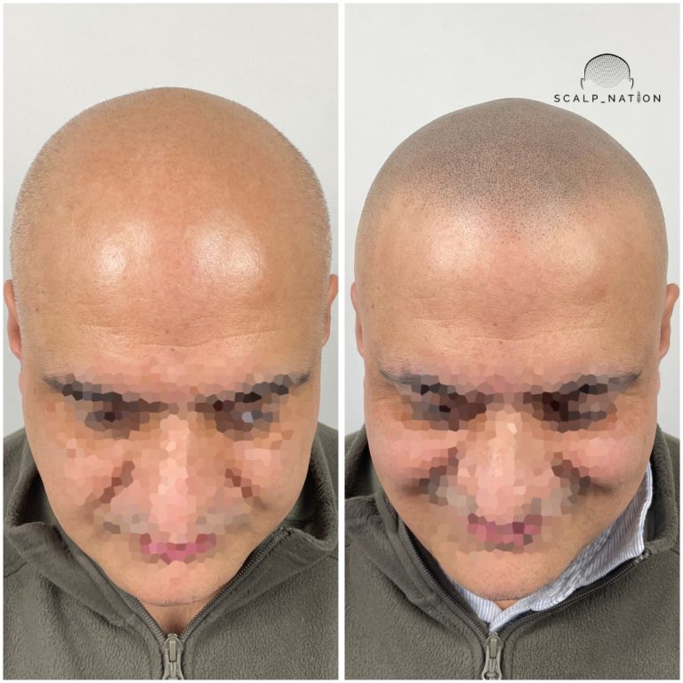 Scalp Micropigmentation Transformation Before And After