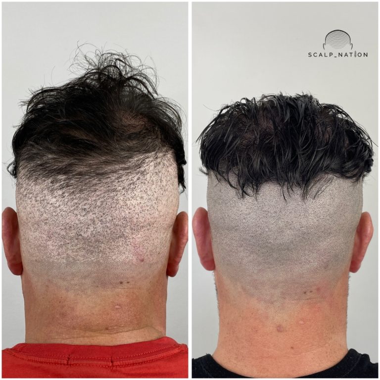 Scalp Micropigmentation Transformation Before And After