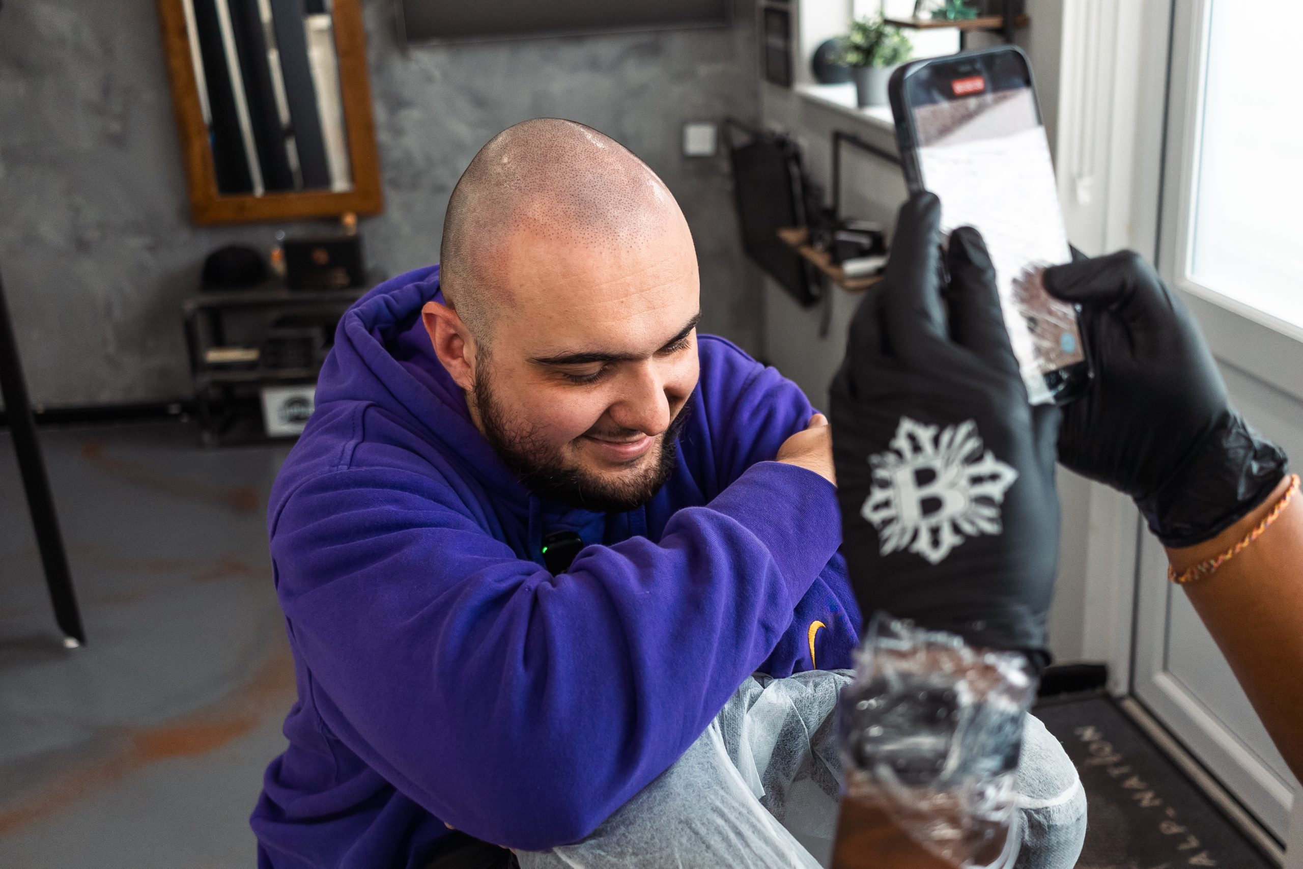 scalp micropigmentation hair loss