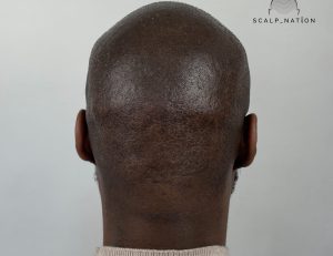 Scalp Micropigmentation for Darker Skin 2 scalp micropigmentation for darker skin