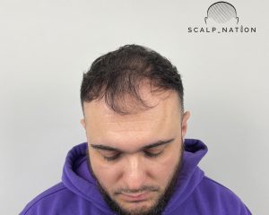 How Male Pattern Hair Loss Develops
