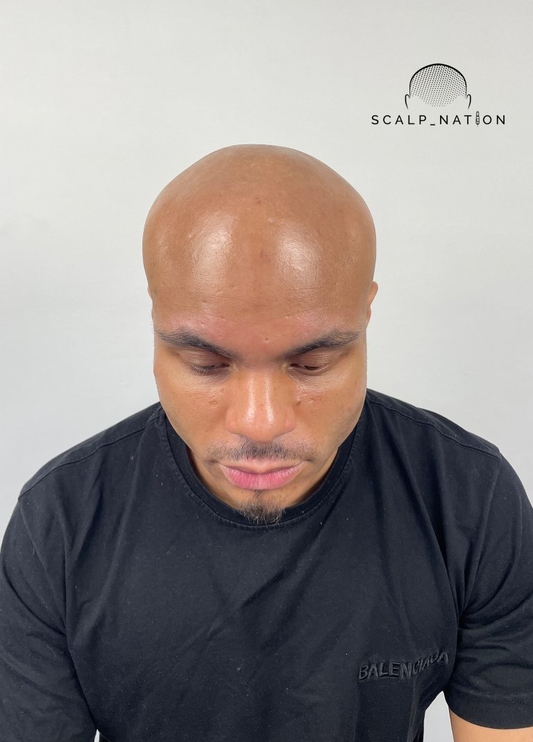 Scalp Micropigmentation Before And After 40 BEFORE Studio Light Front 29