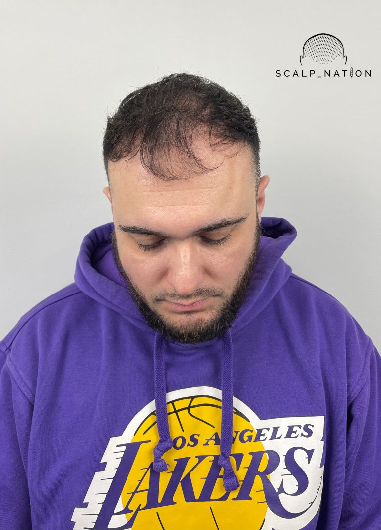 Scalp Micropigmentation Before And After 10 BEFORE Studio Light Front 40