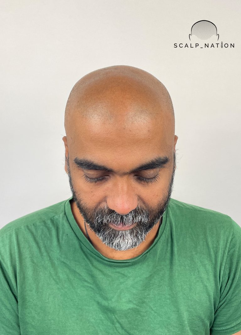Scalp Micropigmentation Before And After 28 BEFORE Studio Light Front 41