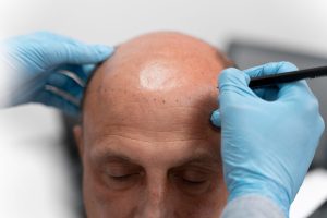 how to fix a bald spot