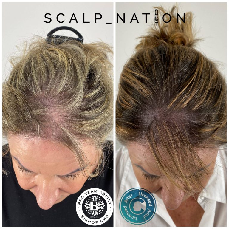 scalp micropigmentation for women before and after