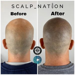 scalp micropigmentation before and after