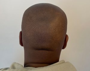Scalp Micropigmentation for Darker Skin 1 SMP for darker skin