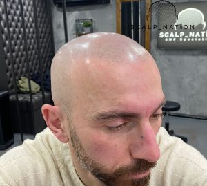 Bald Style Trends That Redefine Confidence and Fashion 10 After Natural Light Side 2 9 scaled e1763740670597