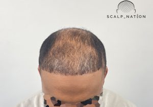 Top Tips to Improve Hair Density 1 Top Tips to Improve Hair Density