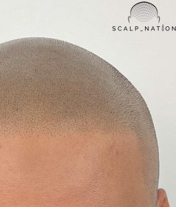 scalp micropigmentation hairline