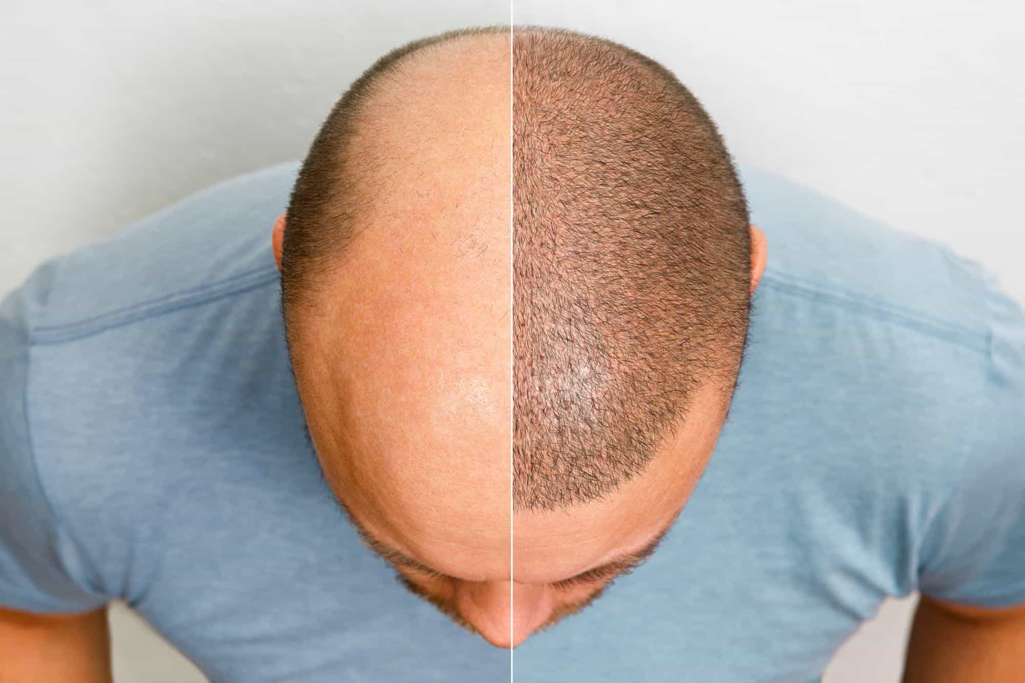 Before and after scalp micropigmentation.