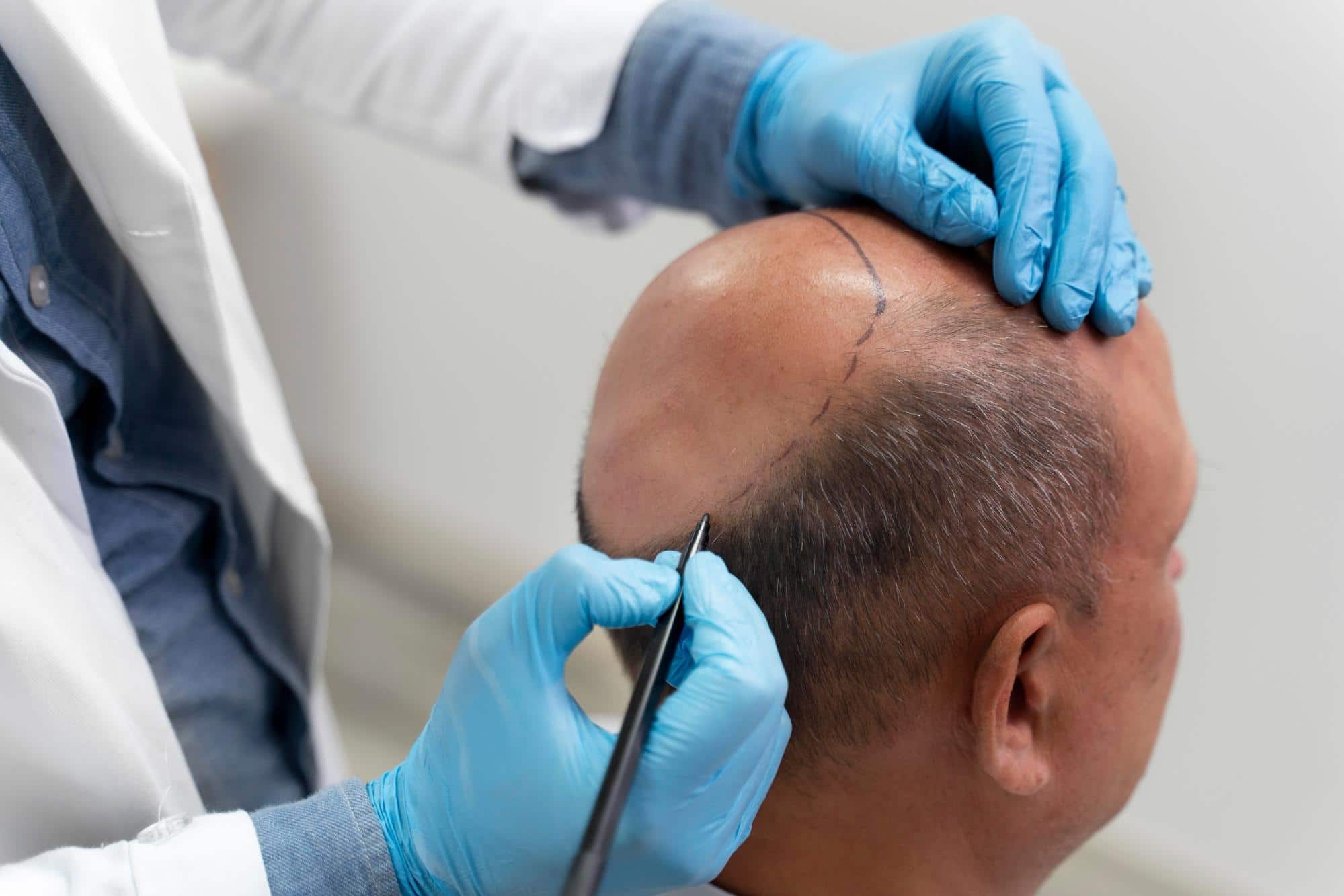 Marking hairline for scalp micropigmentation.