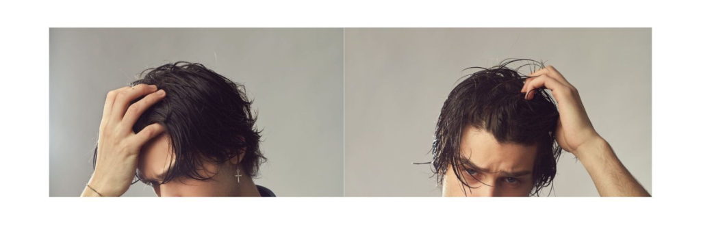 7 Stages of Male Pattern Baldness Using the Norwood Scale (Hamilton-Norwood) 1 Severe hair loss only sides remain – Norwood Scale Stage 7