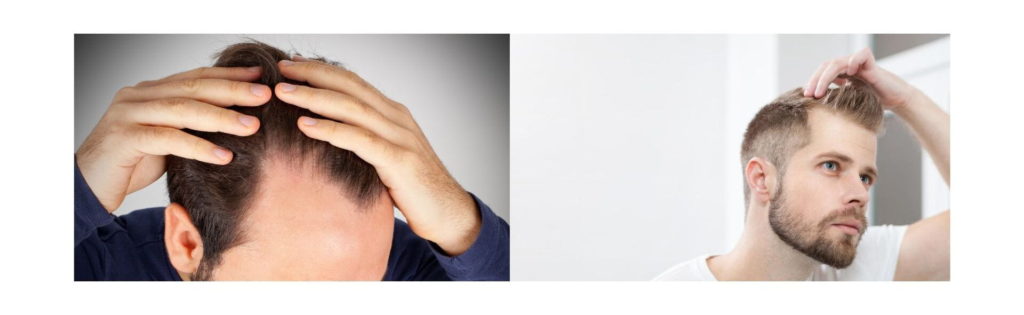 7 Stages of Male Pattern Baldness Using the Norwood Scale (Hamilton-Norwood) 2 Early hairline recession at temples – Norwood Scale Stage 2