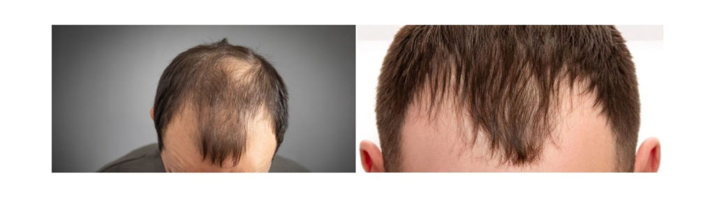 7 Stages of Male Pattern Baldness Using the Norwood Scale (Hamilton-Norwood) 3 Noticeable hairline thinning and crown loss – Norwood Stage 3