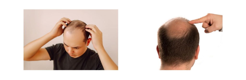 7 Stages of Male Pattern Baldness Using the Norwood Scale (Hamilton-Norwood) 4 Significant hair loss at crown and temples – Norwood Stage 4