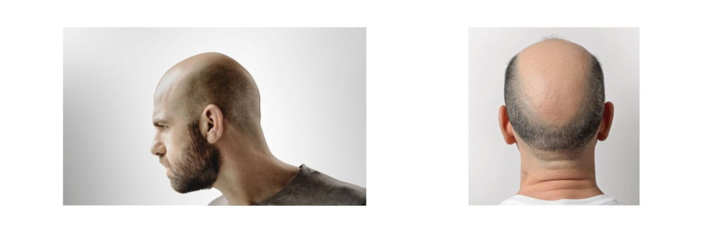 7 Stages of Male Pattern Baldness Using the Norwood Scale (Hamilton-Norwood) 5 Advanced balding with sparse hair bridge – Norwood Stage 5