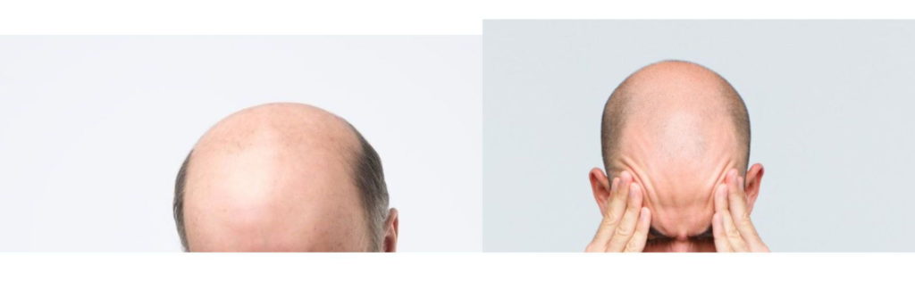 7 Stages of Male Pattern Baldness Using the Norwood Scale (Hamilton-Norwood) 6 Merged crown and temple baldness – Norwood Scale Stage 6