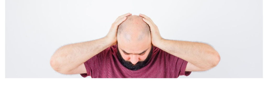 7 Stages of Male Pattern Baldness Using the Norwood Scale (Hamilton-Norwood) 7 Severe hair loss only sides remain – Norwood Scale Stage 7