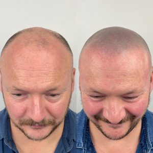 Top Tips to Improve Hair Density 3 scalp micropigmentation
