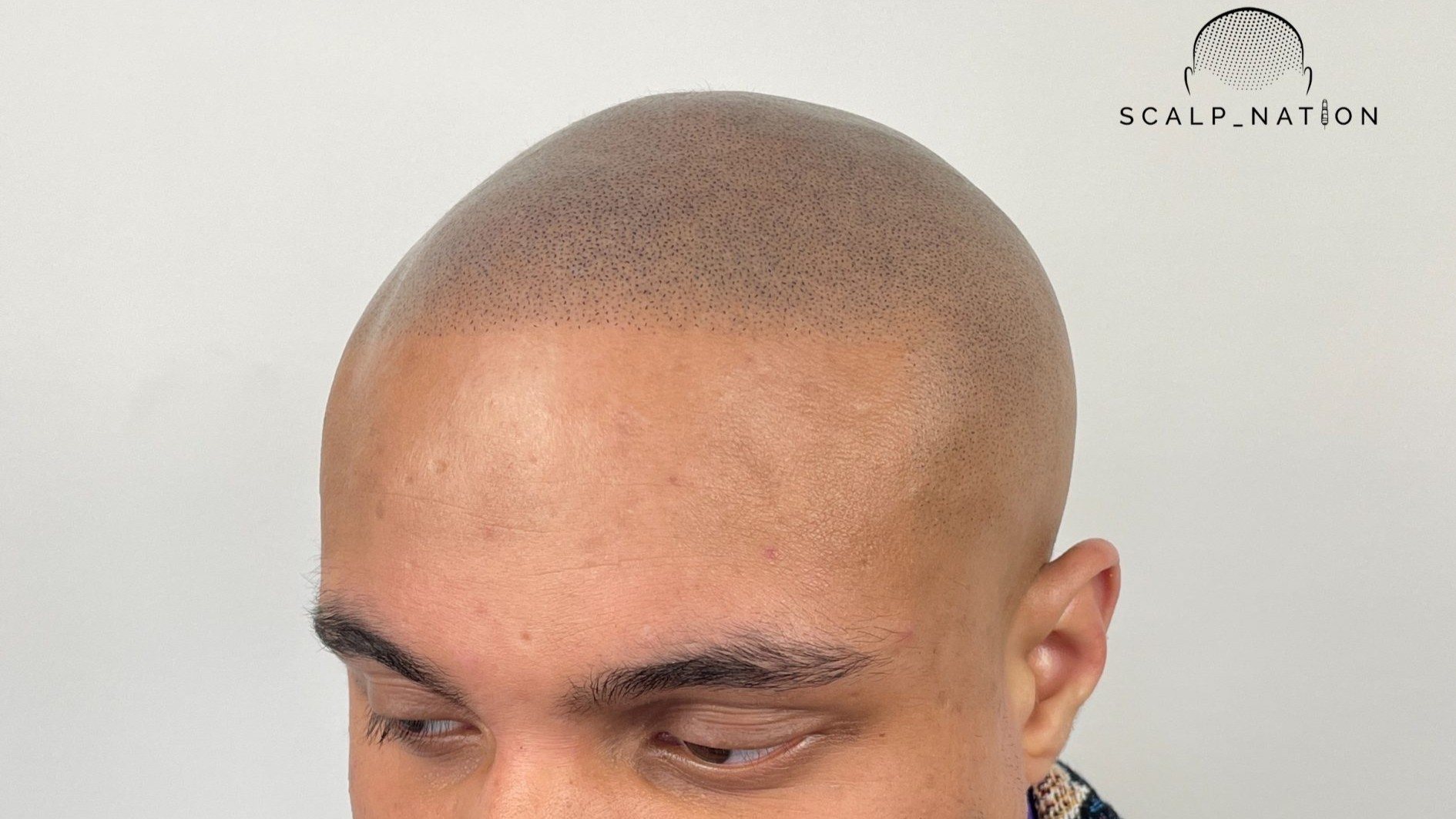Scalp micropigmentation for shaved head look