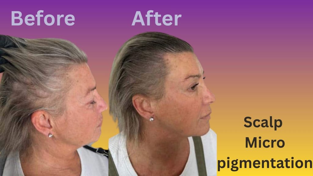 Scalp Micropigmentation result for woman.