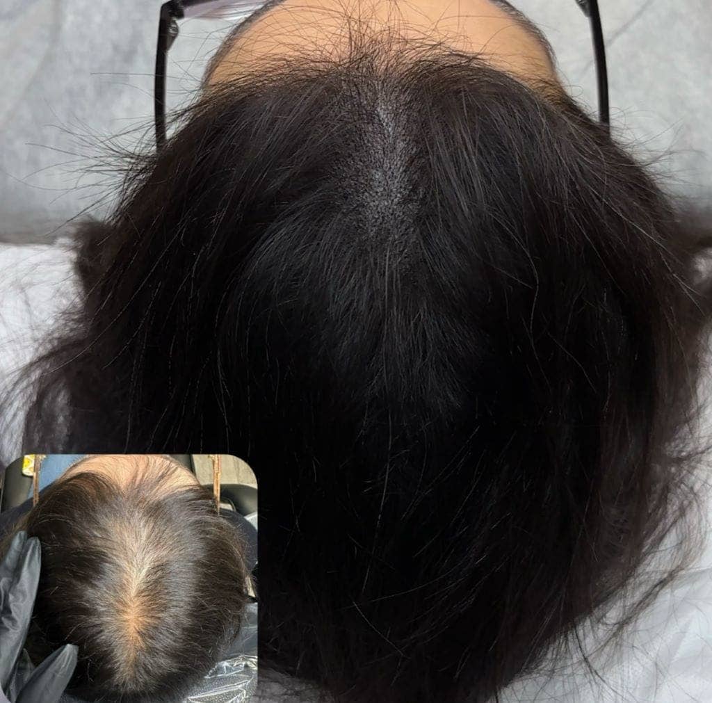 Hair Tattoo for Women & Scalp Micropigmentation Tips 1 Scalp Micropigmentation result on woman's hair part.