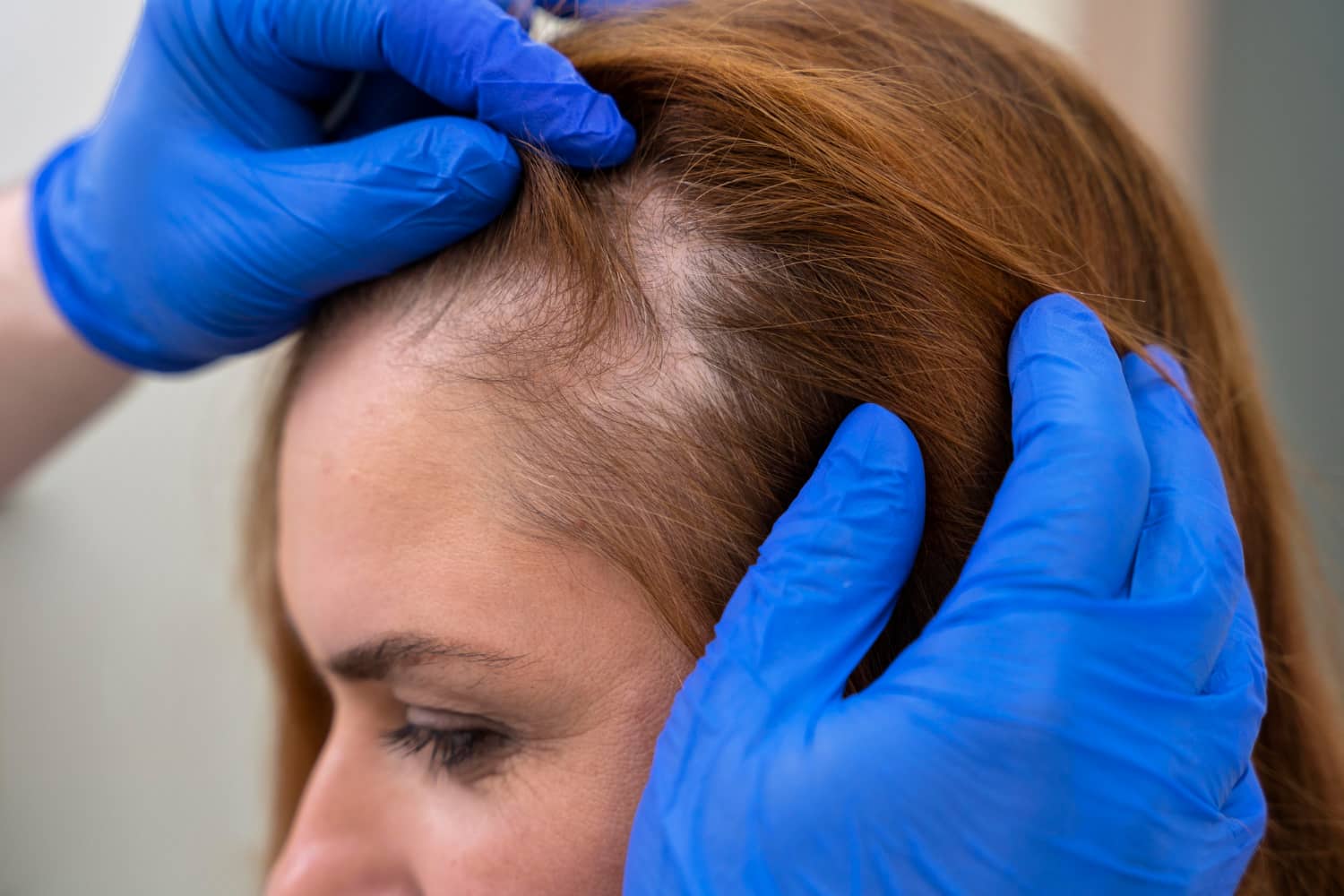 Specialist examining woman’s thinning hair.
