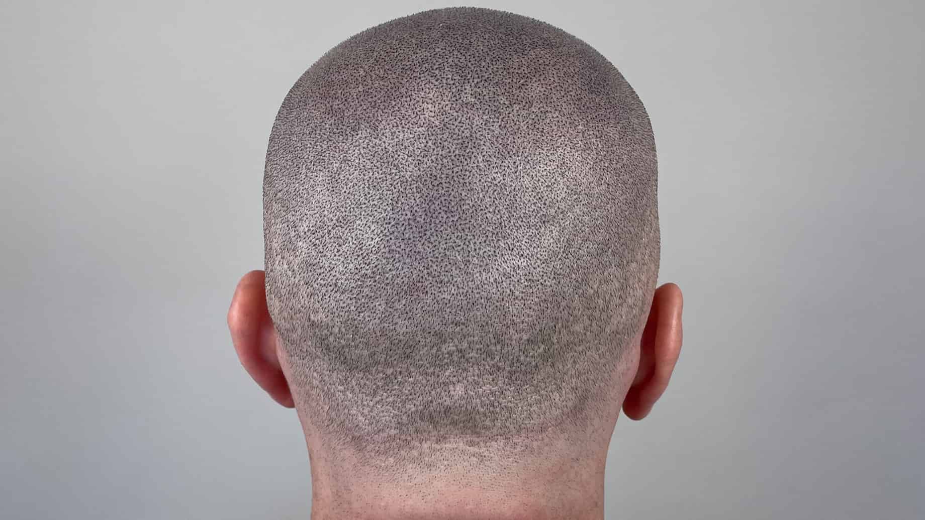 Scalp after a successful SMP treatment.