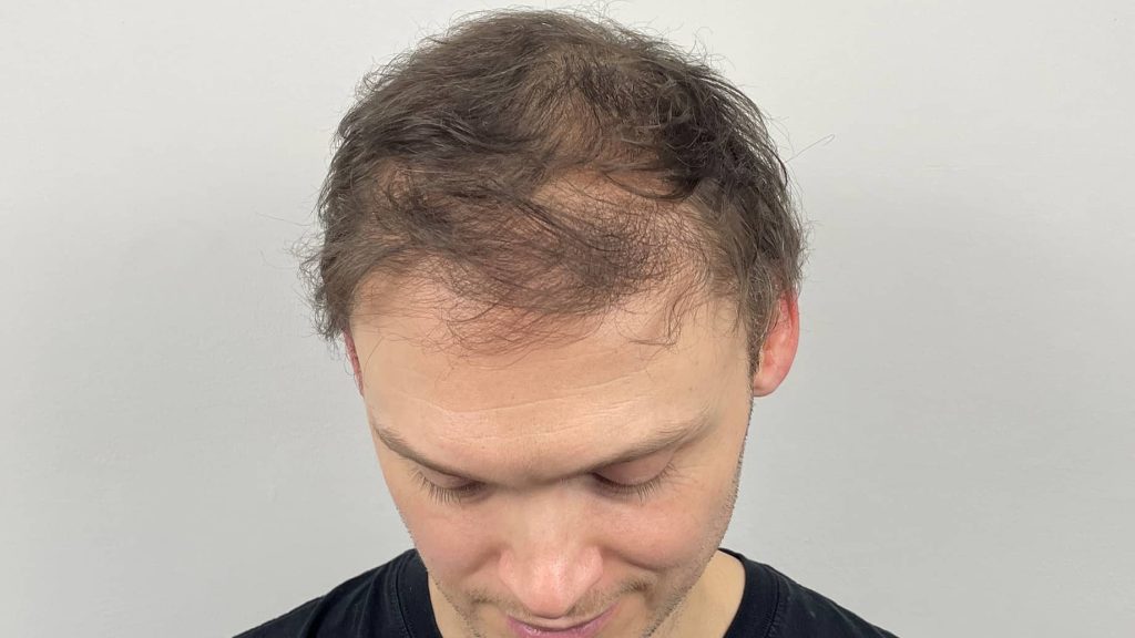 Male Pattern Hair Loss