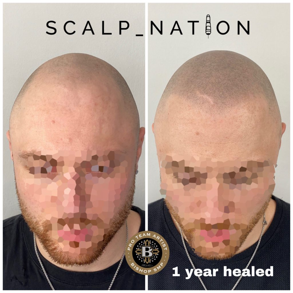 HM1 scalp pigmentation healed 1024x1024 1