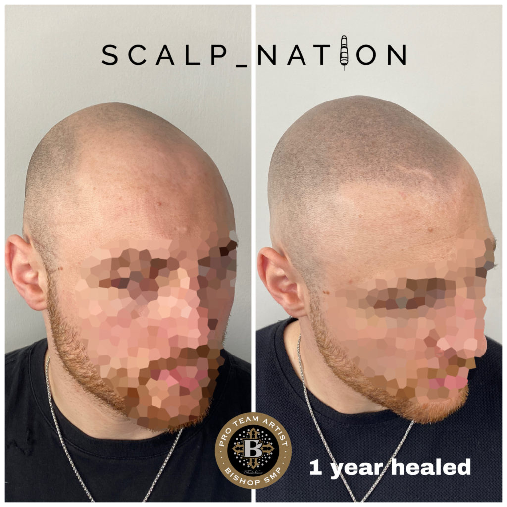 HM2 scalp pigmentation healed 1024x1024 1
